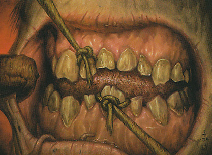 Art for Pulling Teeth by Jim Pavelec. Close up of teeth and gums with multiple teeth being pulled out with twine.